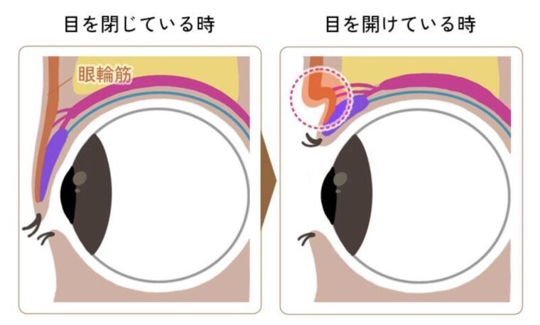 顔面神経麻痺で目が閉じないときは？角膜を守るために大切なこと